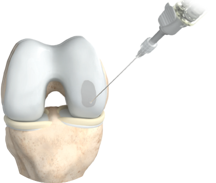 nrs-medical-step4-defektfüllung mit 3d-matrix