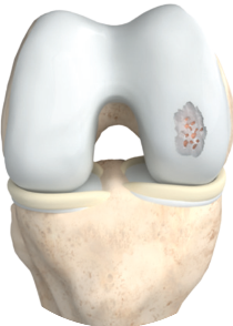 nrs-medical-step1-knorpelschaden