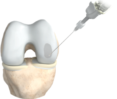 nrs-medical-step4-defektfüllung mit 3d-matrix nrs-medical-step4-defektfüllung mit 3d-matrix